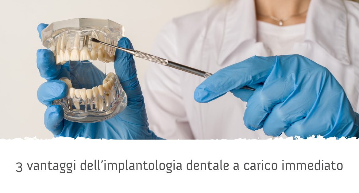 implantologia dentale a carico immediato vantaggi